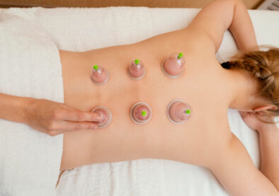 Cupping Therapy 2