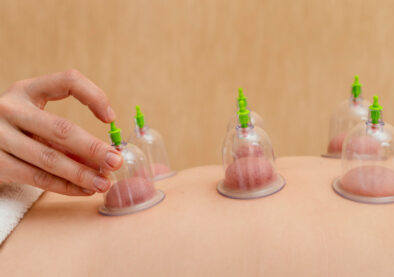 Cupping Therapy 3